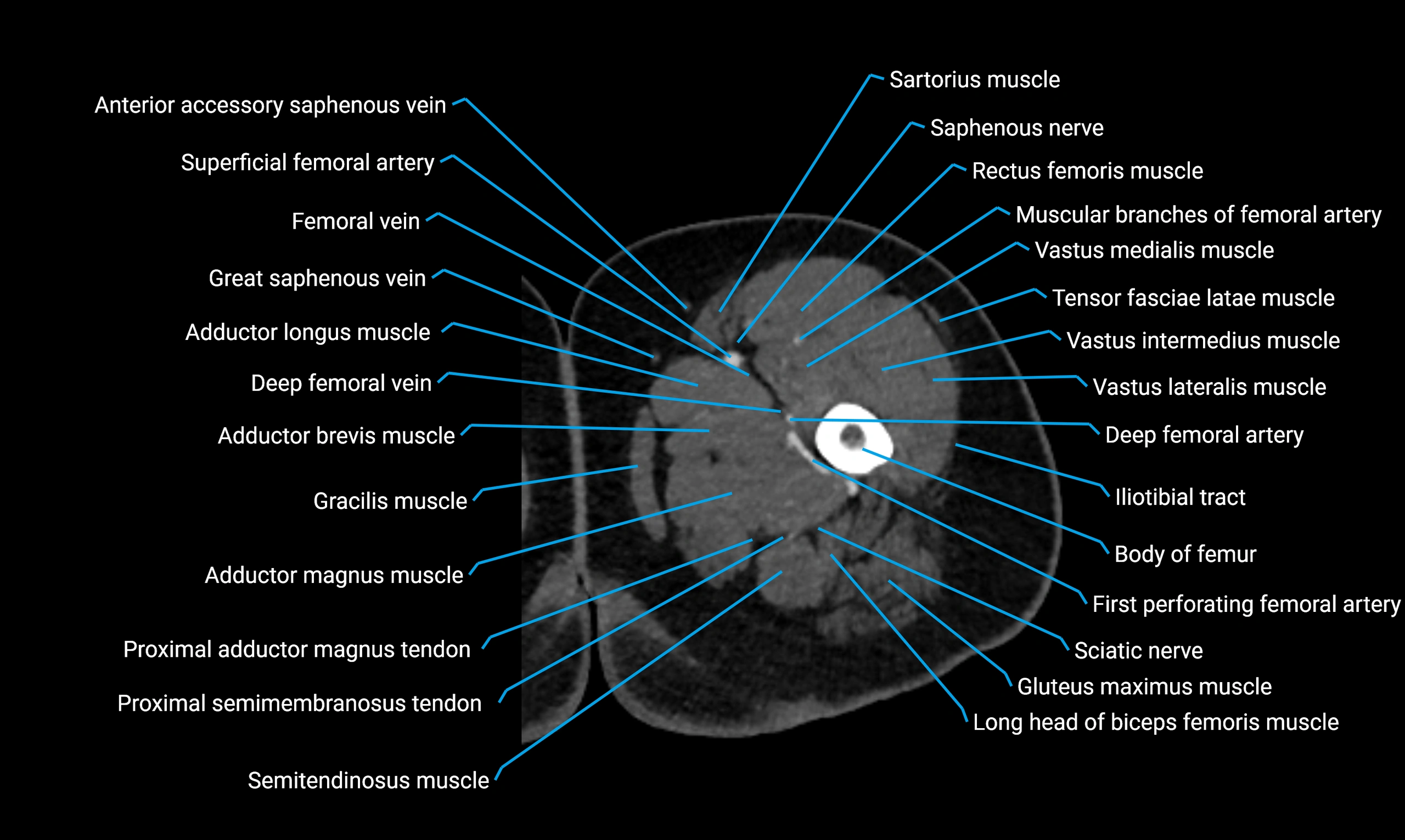 CT thigh axial cross sectional anatomy labelled image_29 (2).webp